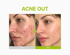 Purito SEOUL - Azelaic Acid 10 Kojic Tea Tree Serum 30ml