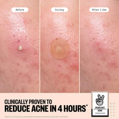 PEACE OUT - 4 ACNE HEALING DOTS